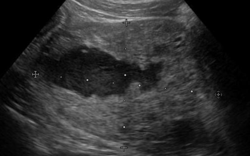 前立腺膿瘍のエコー画像です。前立腺中央に黒い袋があり、これが膿瘍です。また、この症例の前立腺は肥大していました。